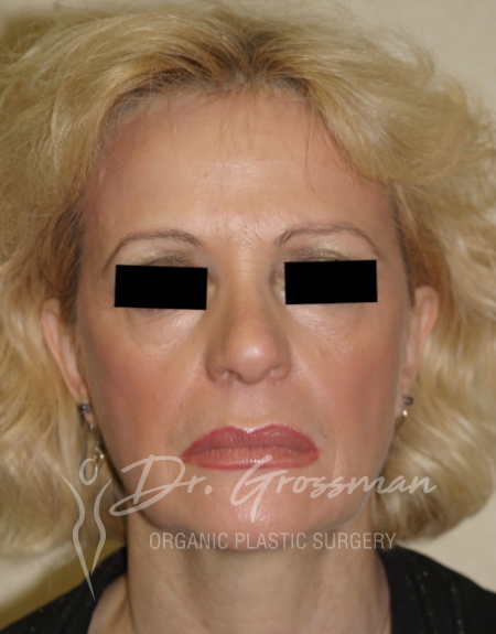 Before & After Face Rejuvenation | New York City Plastic Surgery PC