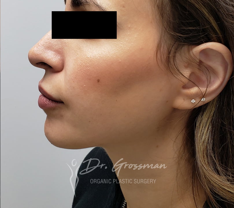 Facial Rejuvenation 99 facerejuvenation4 before