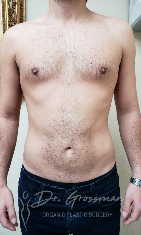 Liposuction 33 Flank Liposuction in New York City Plastic Surgery PC