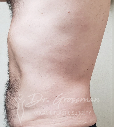 Flank Liposuction Male in New York City Plastic Surgery PC