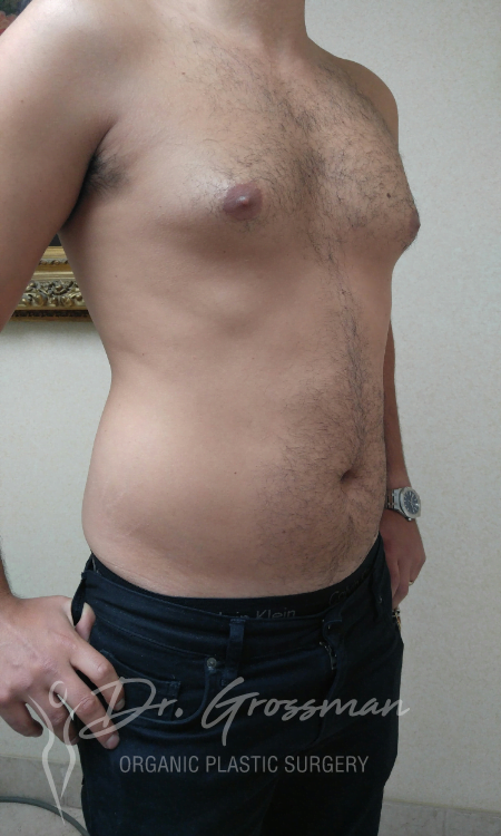 Flank Liposuction Male in New York City Plastic Surgery PC
