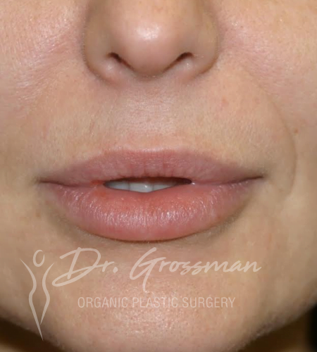 lip augmentation with HA filler 1 2