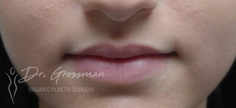 lip augmentation with HA filler 1
