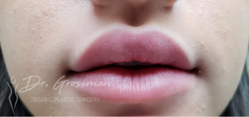 lip augmentation with HA filler 2