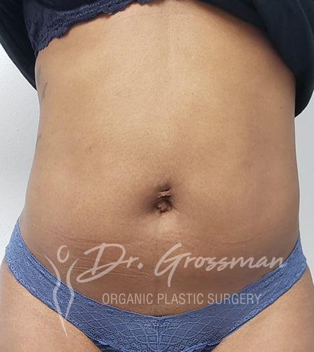 Liposuction 57 liposuction after3