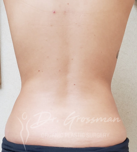 liposuction of flanks muffin top 1