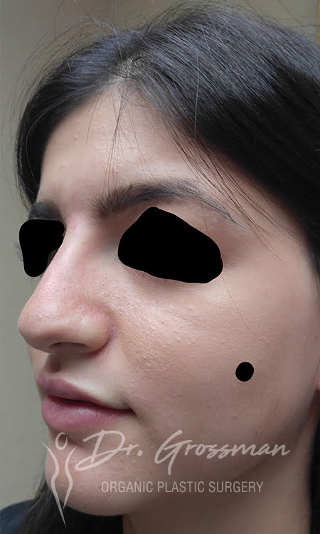 Restylane Injections 19 nose after