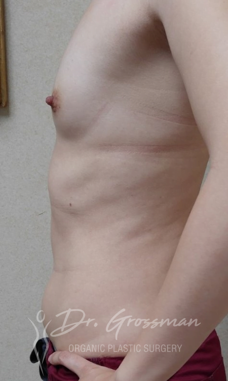 Before And After Breast Lifts | Dr. Leonard Grossman M.D. | NY