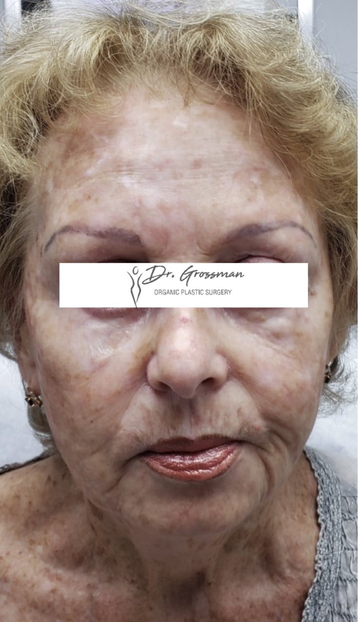 Facial Rejuvenation 59 thumbnail image0