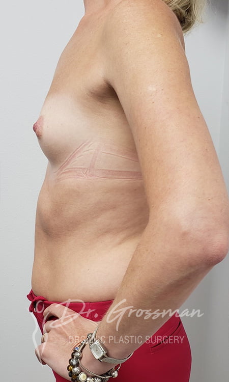 transumbilical breast augmentation1