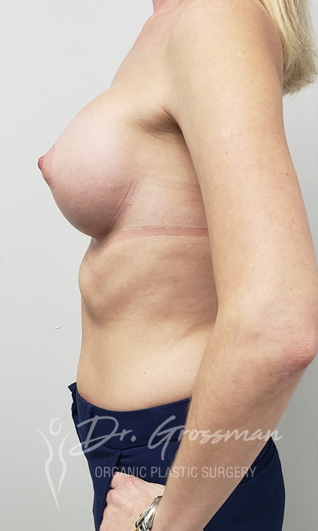 transumbilical breast augmentation2