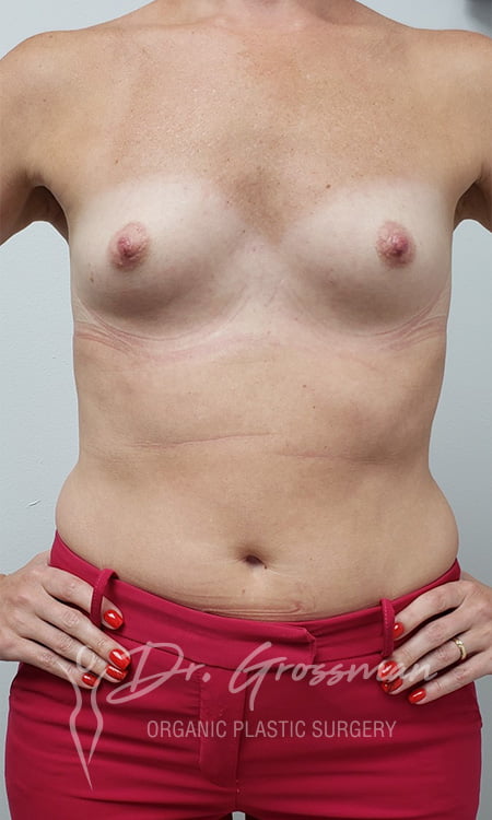 transumbilical breast augmentation3