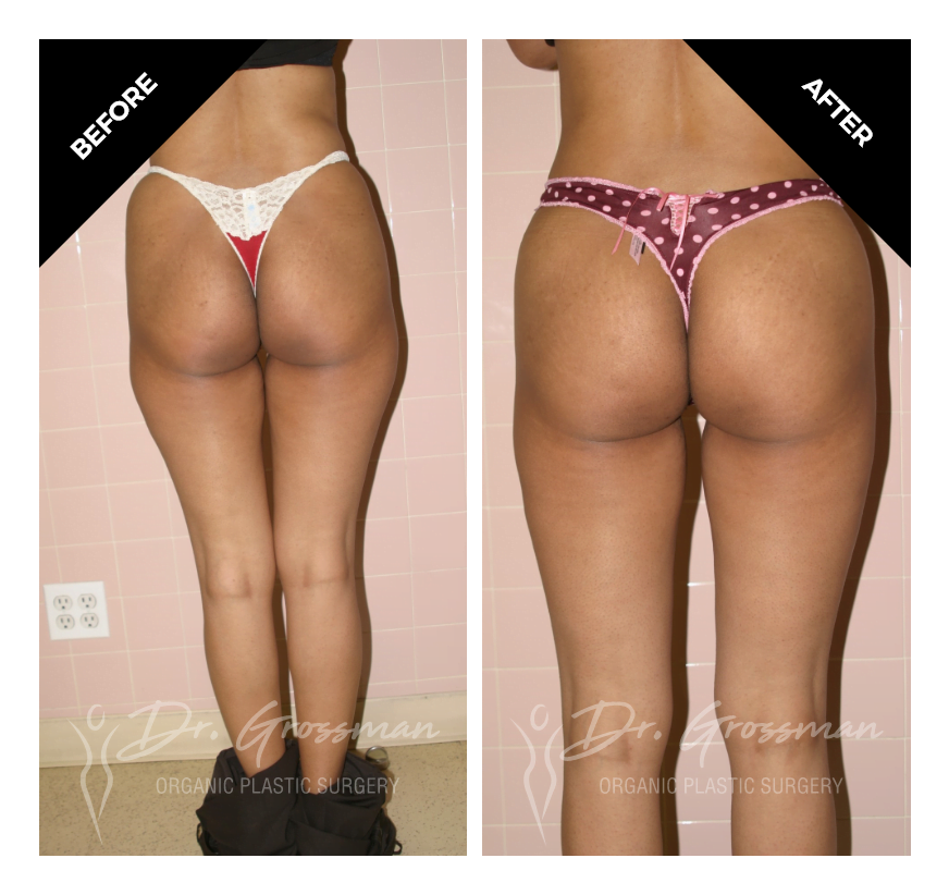 Before and After Brazilian butt lift | Dr. Leonard Grossman M.D. | New York