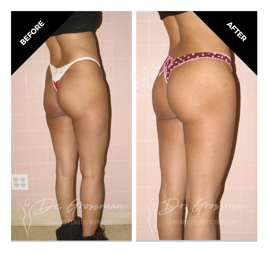 Before and After Brazilian butt lift | Dr. Leonard Grossman M.D. | New York