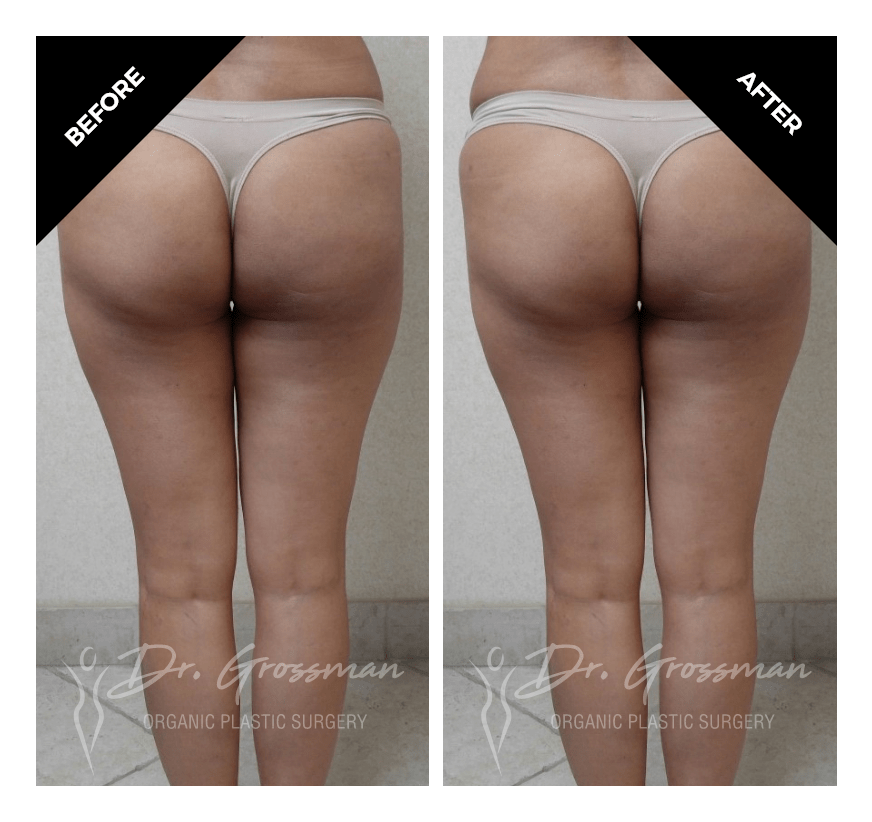 Before and After Bowed Leg Correction | Dr. Leonard Grossman M.D. | New York