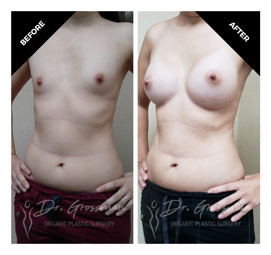 TUBA breast augmentation with saline implants 2