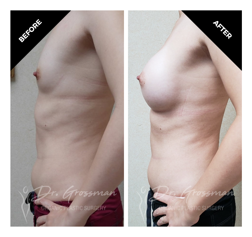 TUBA breast augmentation with saline implants 3