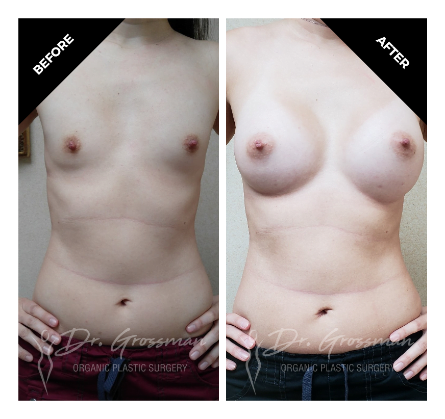 TUBA breast augmentation with saline implants