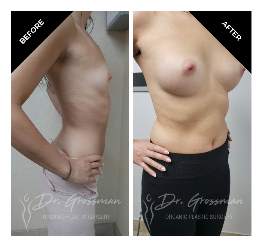 Before and After TUBA transumbilical breast augmentation | Dr. Leonard Grossman M.D. | New York