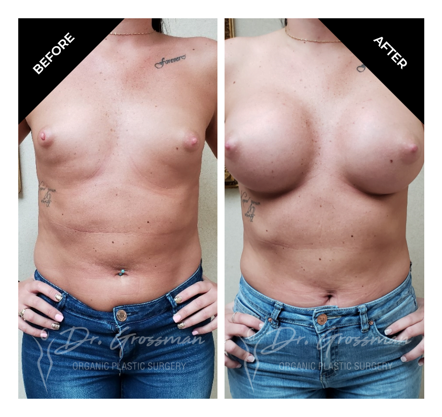 Before and After TUBA transumbilical breast augmentation | Dr. Leonard Grossman M.D. | New York
