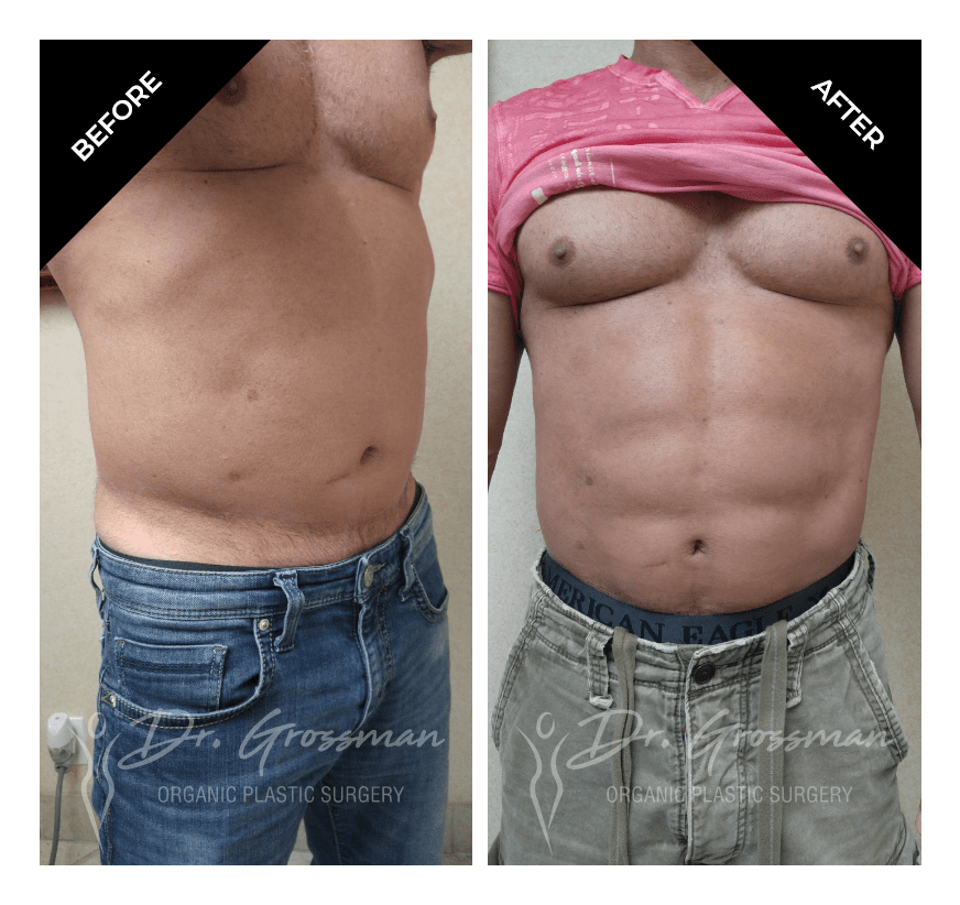 Before and After Abdominal Etching | Dr. Leonard Grossman M.D. | New York
