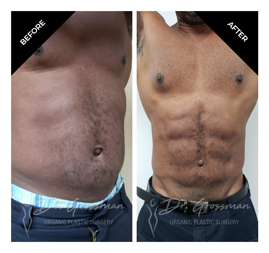 Before and After Abdominal Lipoetching | Dr. Leonard Grossman M.D. | New York