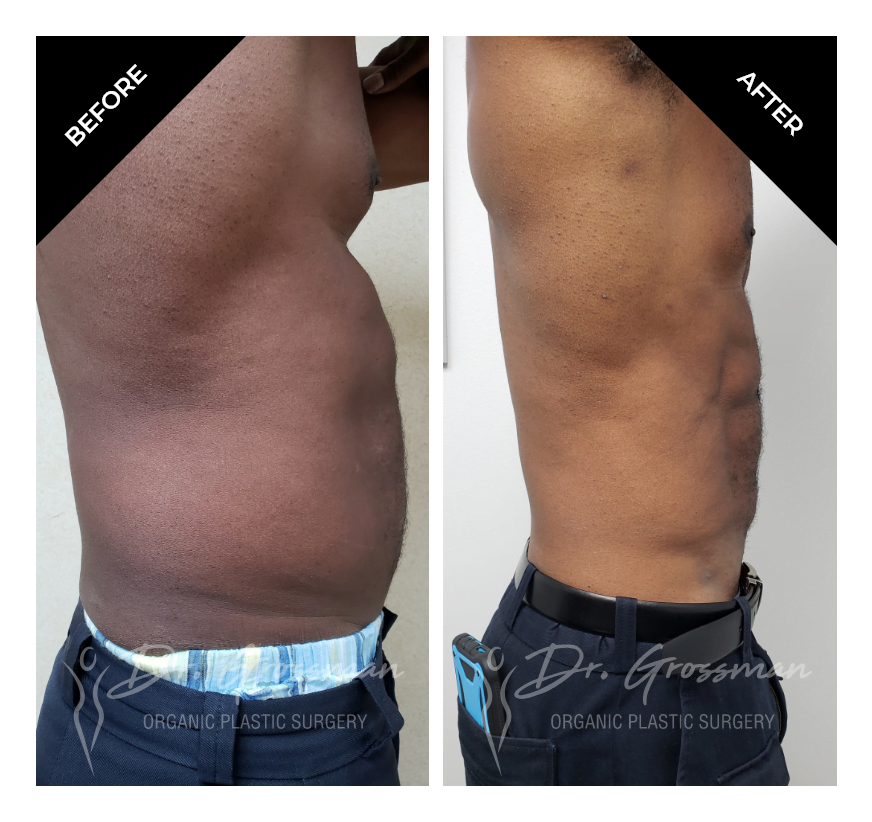 Before and After Abdominal Lipoetching | Dr. Leonard Grossman M.D. | New York