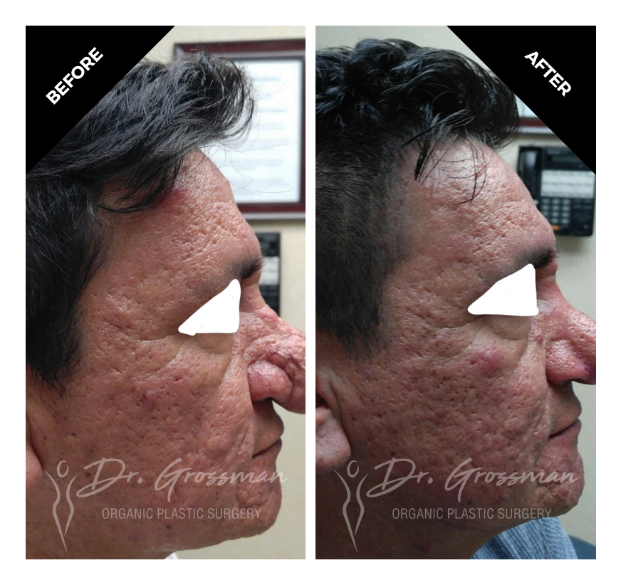 before and after rhinophyma treatment with renuvion services