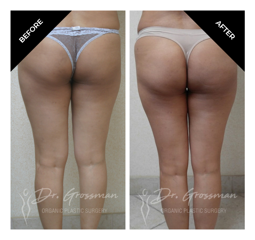 Before and After Bowed leg correction | Dr. Leonard Grossman M.D. | New York