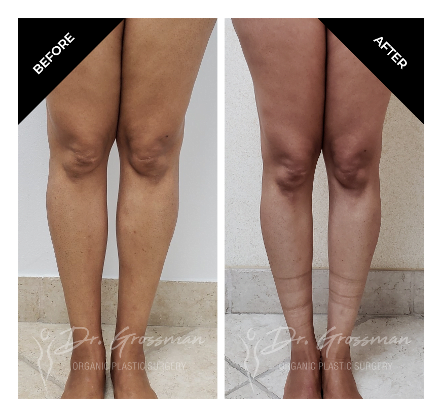 Before and After Bowed leg correction with Fat grafting | Dr. Leonard Grossman M.D. | New York