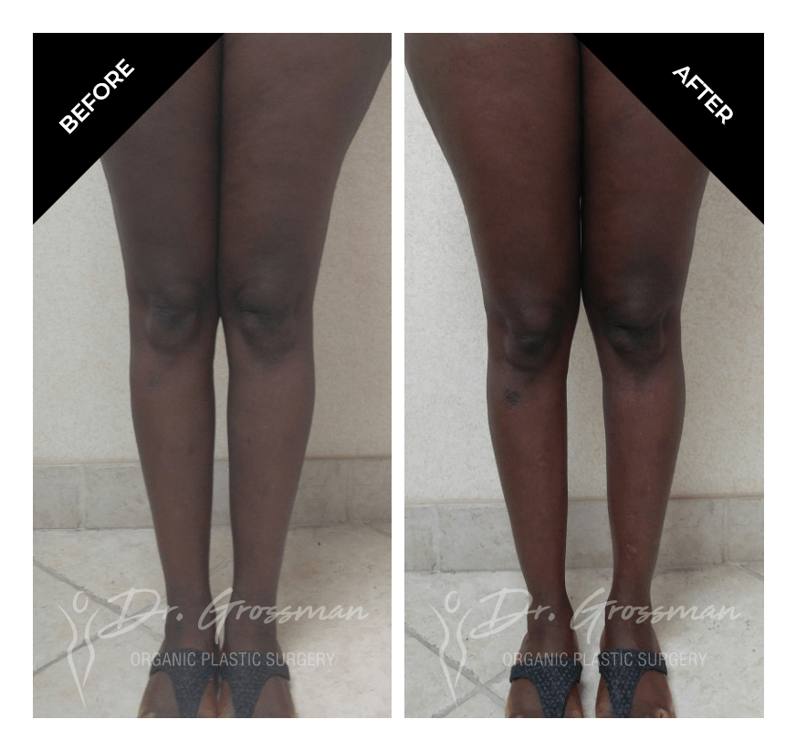 Before and After Bowed leg correction with Fat transfer | Dr. Leonard Grossman M.D. | New York