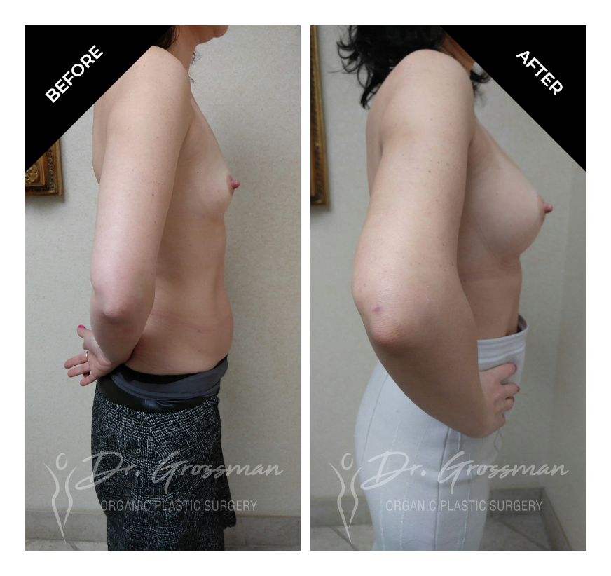 Before and After Breast Aug with Fat | Dr. Leonard Grossman M.D. | New York