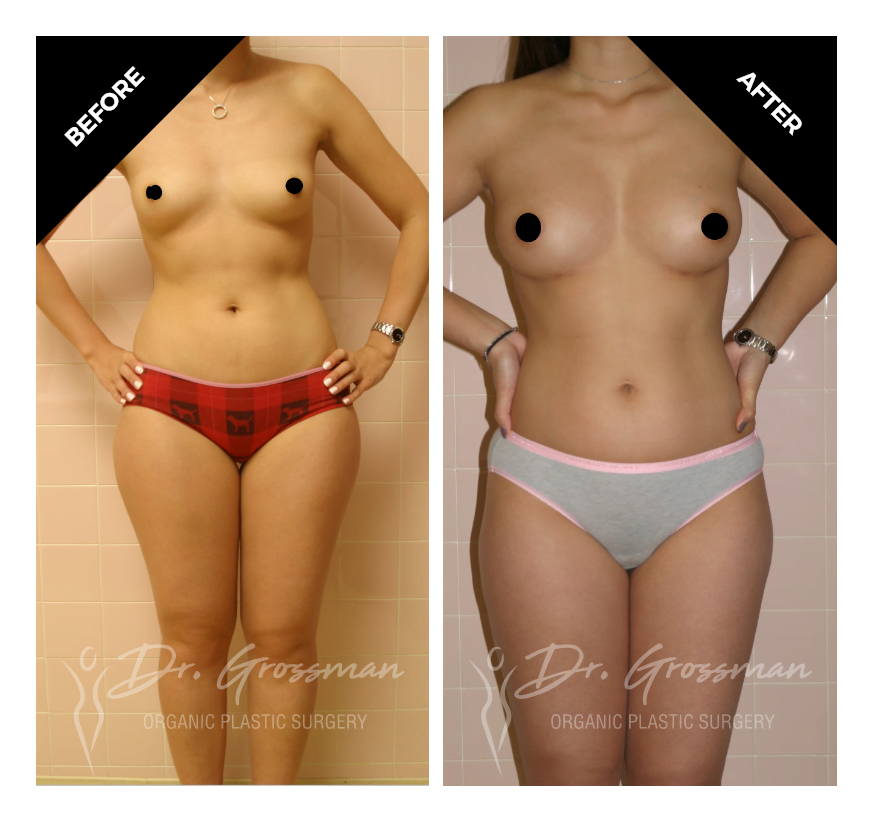 Before and After Breast Augmentation with Fat Transfer | Dr. Leonard Grossman M.D. | New York