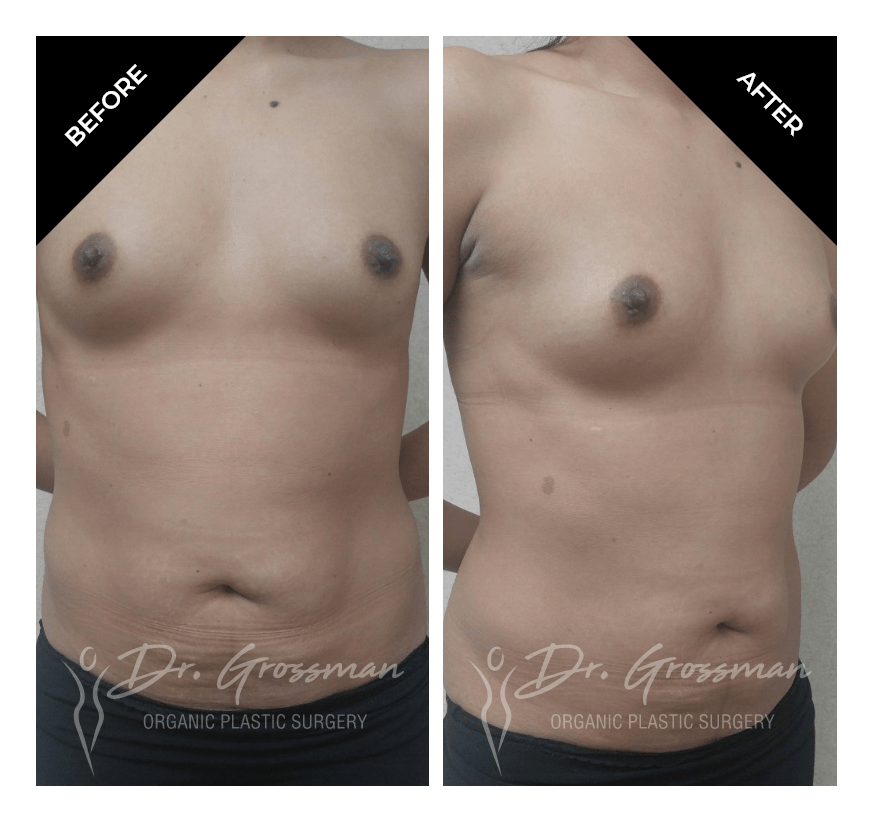 Before and After Breast Augmentation with Fat | Dr. Leonard Grossman M.D. | New York