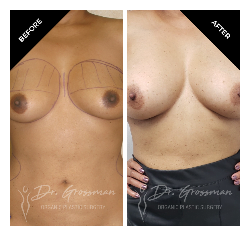 Before and After Breast Augmentation with Fat | Dr. Leonard Grossman M.D. | New York