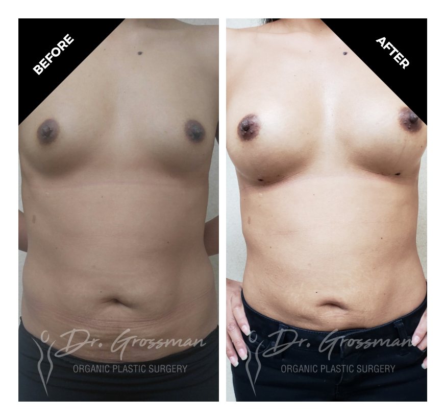 Before and After Breast Augmentation with Fat Transfer | Dr. Leonard Grossman M.D. | New York