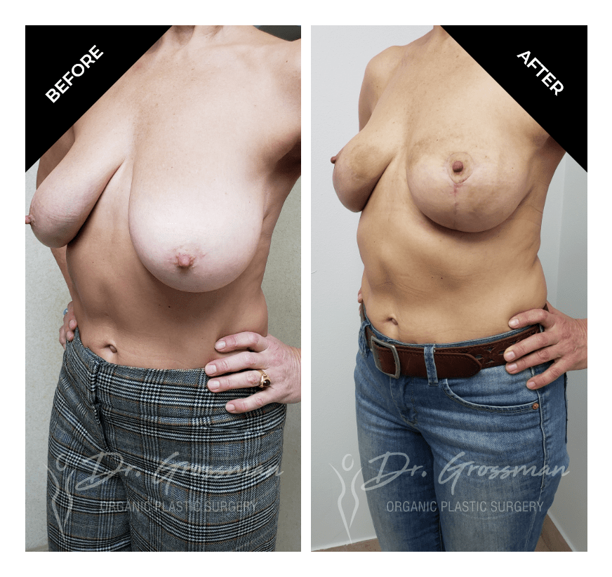 Before and After Breast reduction short anchor scar | Dr. Leonard Grossman M.D. | New York