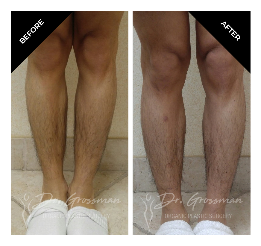 Before and After Calf Augmentation with Fat | Dr. Leonard Grossman M.D. | New York