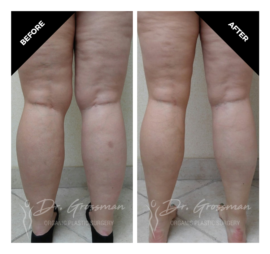 cankle liposuction 1
