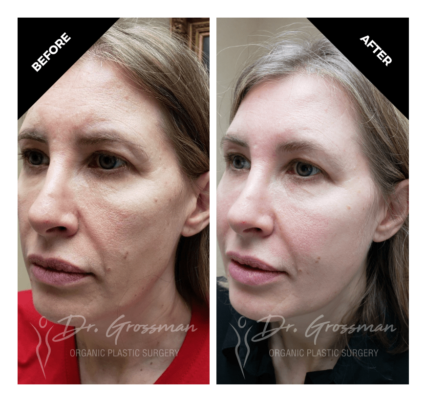 face rejuvenation with fat grafting 1 3