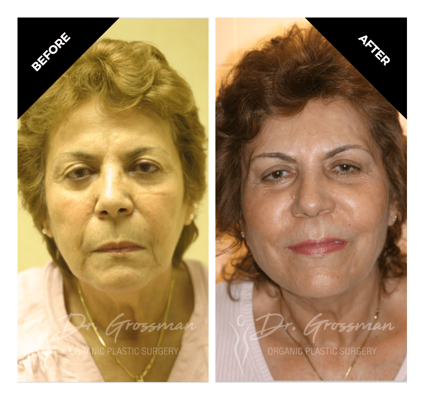 face rejuvenation with fat grafting 2