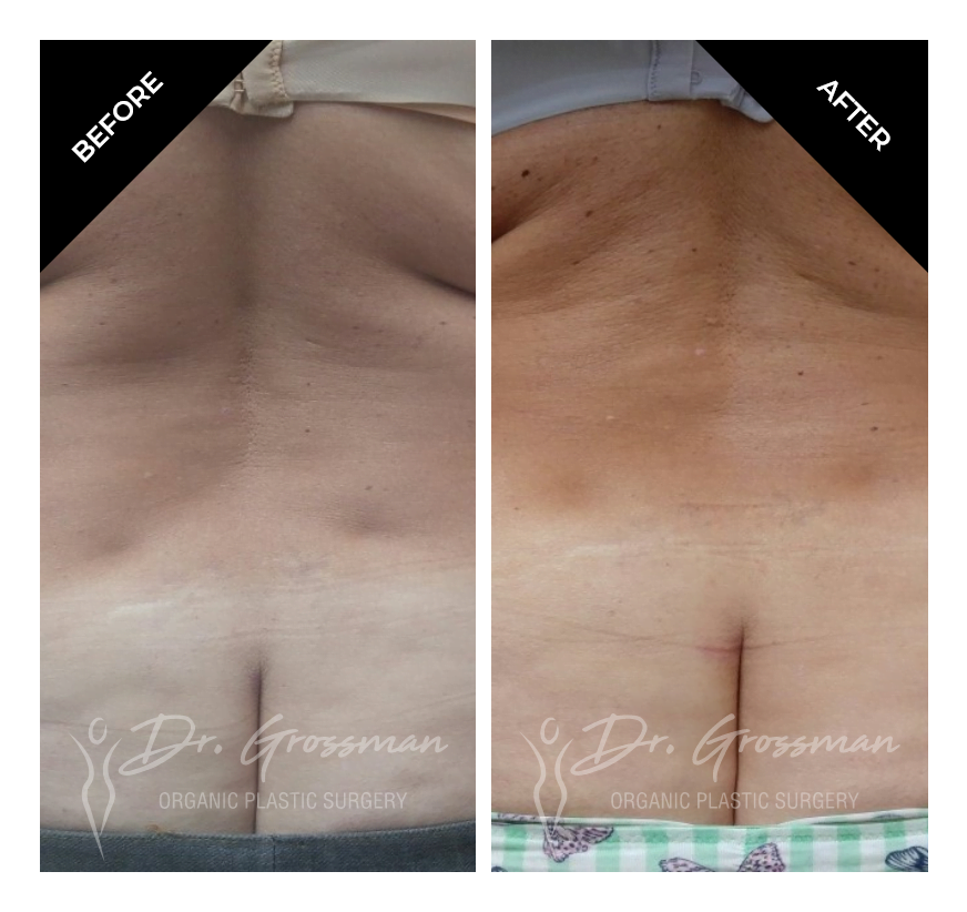 Before and After Flank Liposuction | Dr. Leonard Grossman M.D. | New York