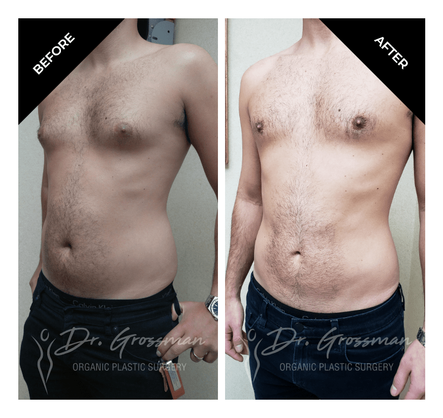 Before and After Gynecomastia and Flank Liposuction | Dr. Leonard Grossman M.D. | New York