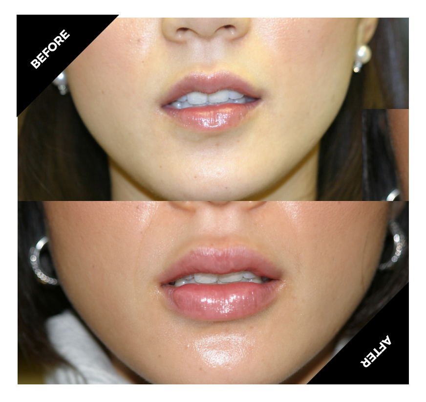 lip augmentation with HA fillers