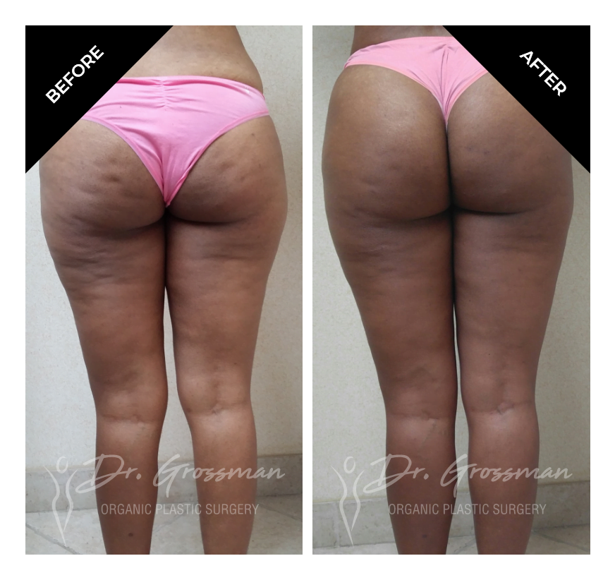 Before and After Liposuction calf augmentation | Dr. Leonard Grossman M.D. | New York