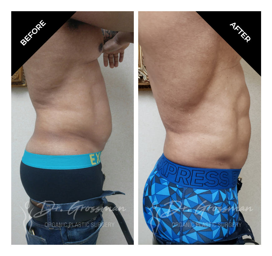 Before and After Liposuction of Flanks muffin top | Dr. Leonard Grossman M.D. | New York