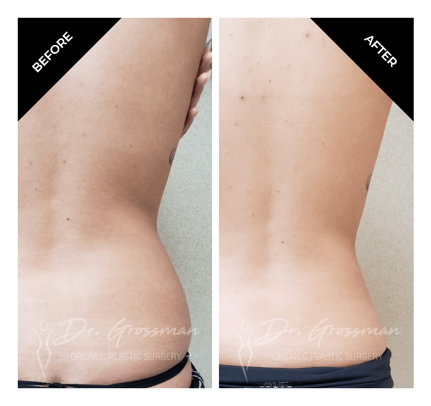 Before and After Liposuction of Flanks muffin top | Dr. Leonard Grossman M.D. | New York