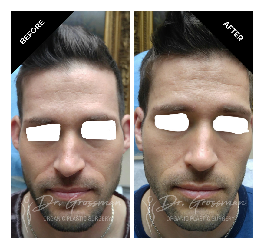 Before and After Otoplasty Ear Reshaping treatment | Dr. Leonard Grossman M.D. | New York