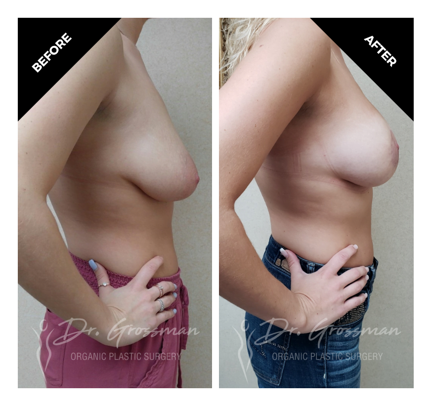 periareolar breast lift – 1 3