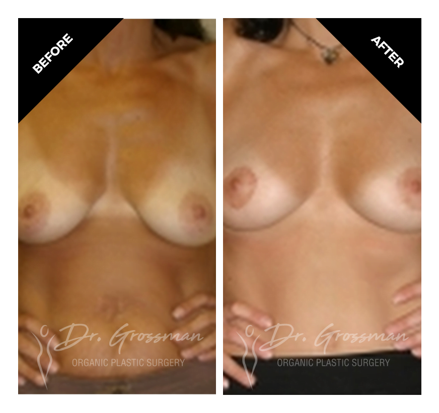 periareolar breast lift